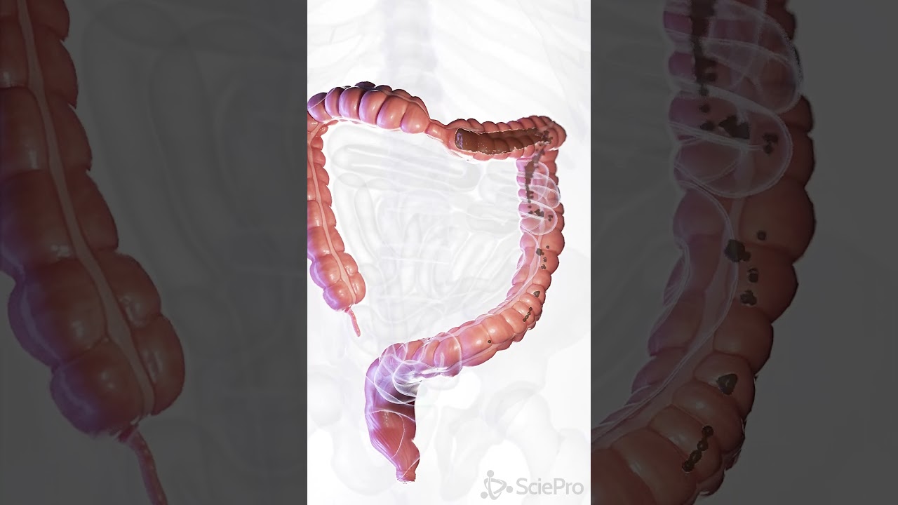 💧 Understanding Diarrhea: Causes and Care 💧  #anatomy #meded #3danimation